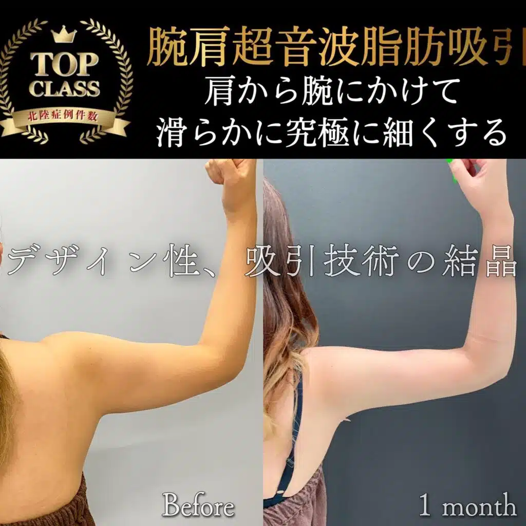 腕肩超音波脂肪吸引　名古屋