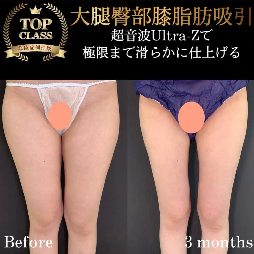 大腿臀部膝脂肪吸引　名古屋