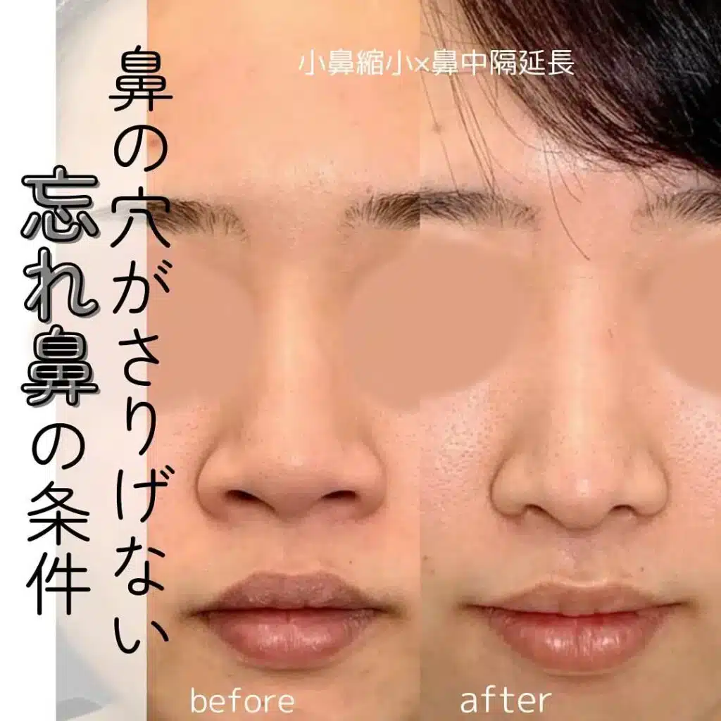 小鼻縮小×鼻中隔延長　名古屋