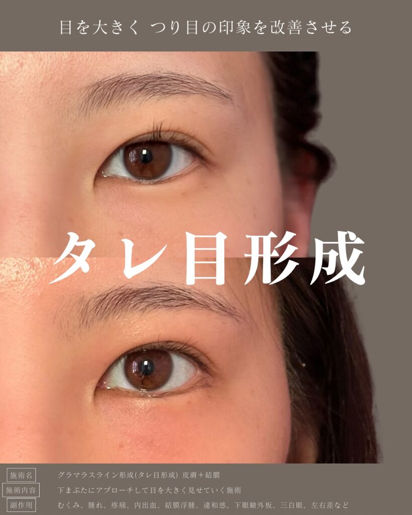 タレ目形成の症例写真 (7)
