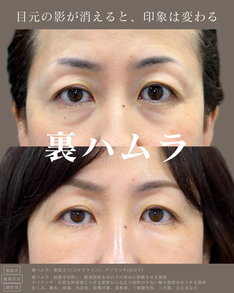 裏ハムラ法の症例写真 (2)
