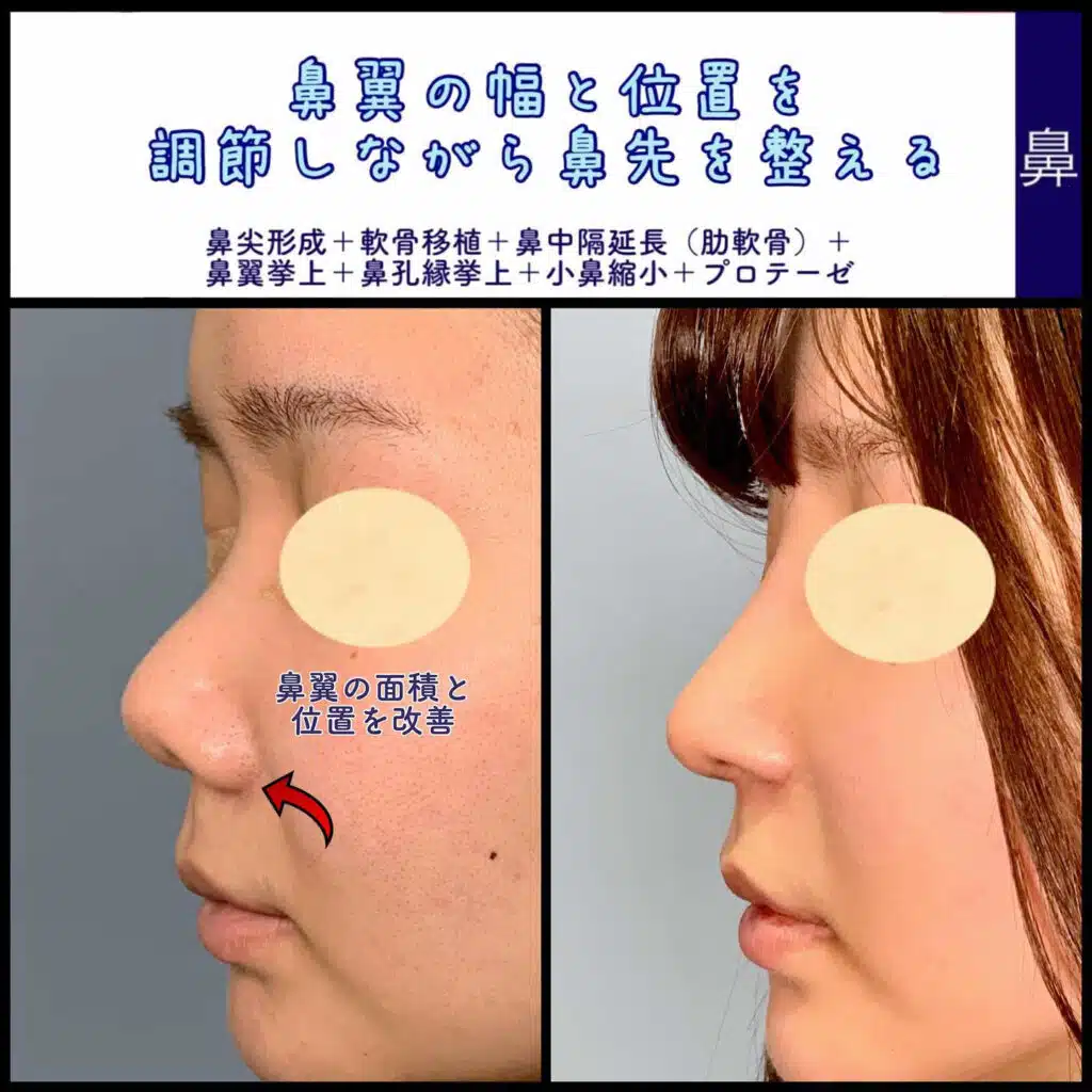 鼻尖形成+軟骨移植+鼻中隔延長（肋軟骨）+鼻翼挙上+鼻孔縁挙上+小鼻縮小+プロテーゼ　名古屋