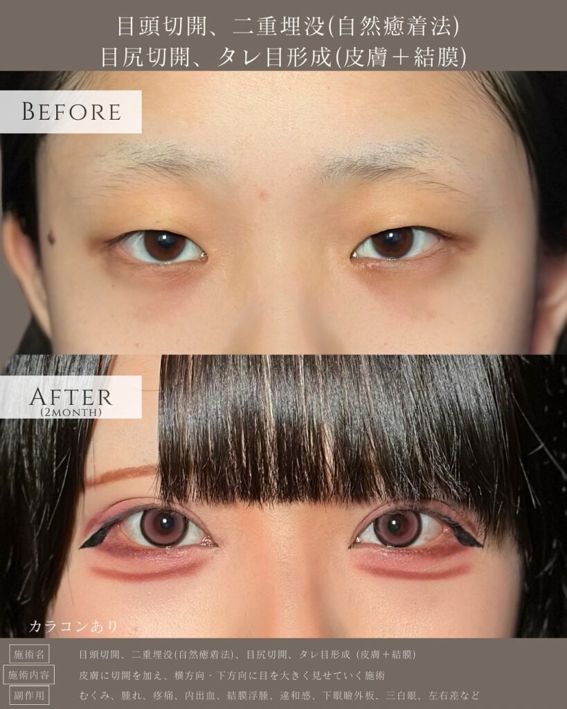目頭切開と埋没法と目尻切開とタレ目形成の症例写真