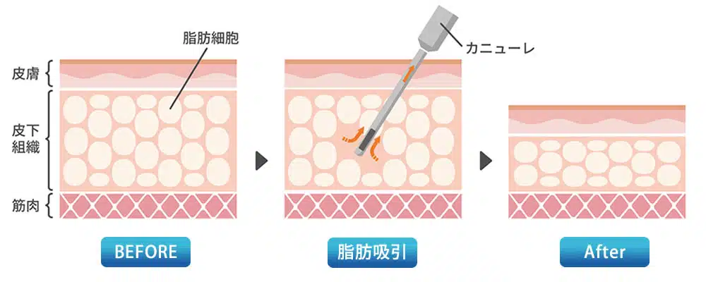 脂肪吸引　図解　名古屋