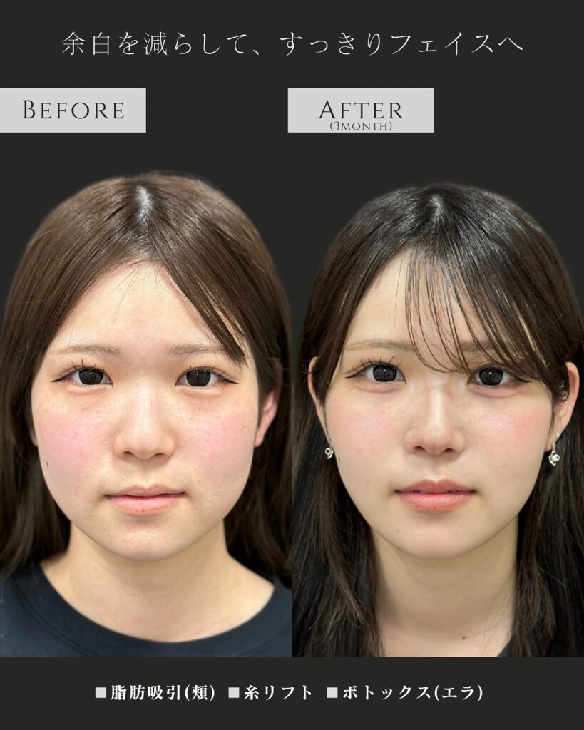 頬の脂肪吸引と糸リフトとエラボトックスの症例写真