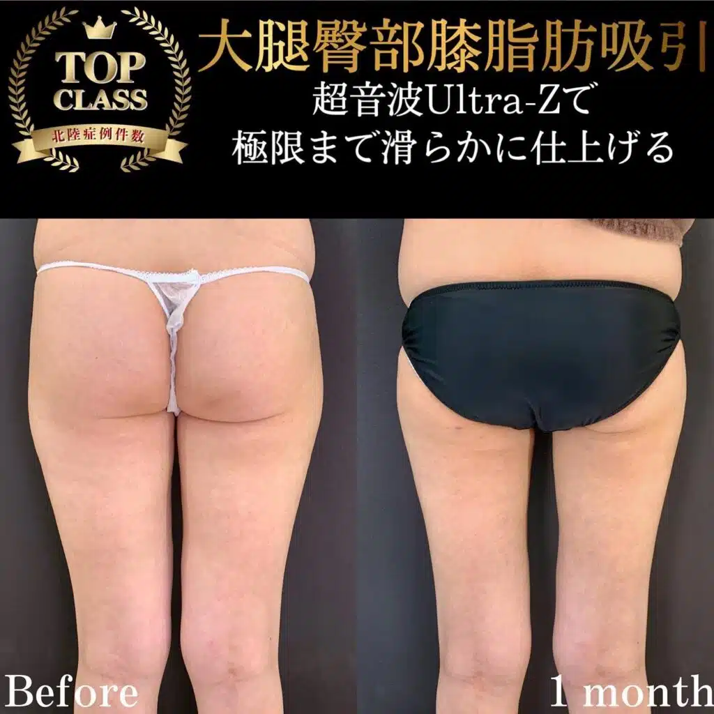 大腿臀部膝脂肪吸引　名古屋