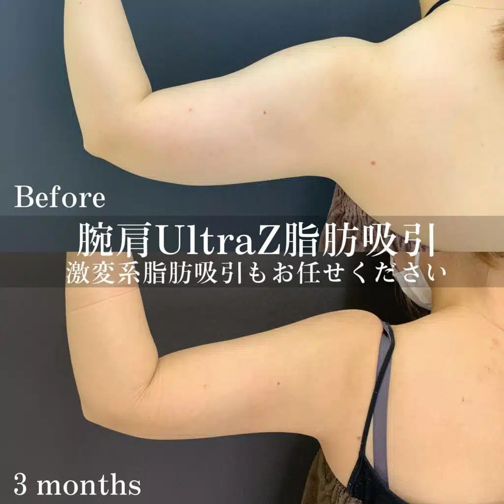 腕肩UltraZ脂肪吸引　名古屋