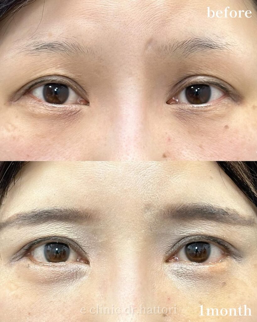 目尻切開とタレ目形成の症例写真 (1)