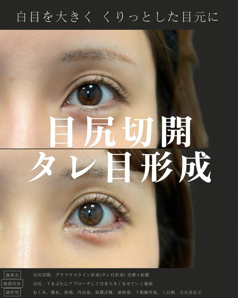 目尻切開とタレ目形成の症例写真 (3)