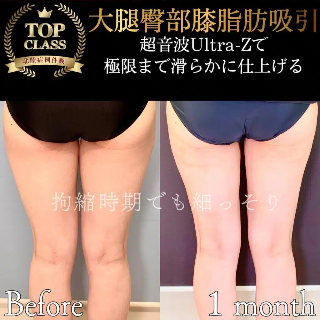 大腿臀部膝脂肪吸引　名古屋