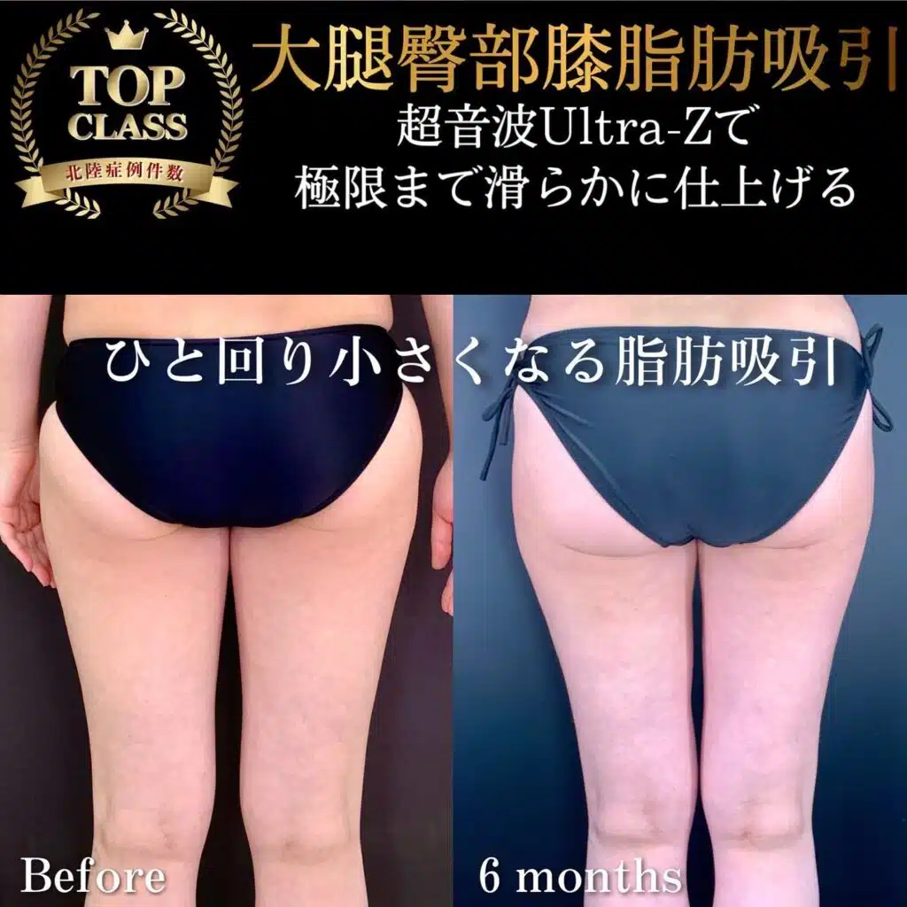 大腿臀部膝脂肪吸引　名古屋
