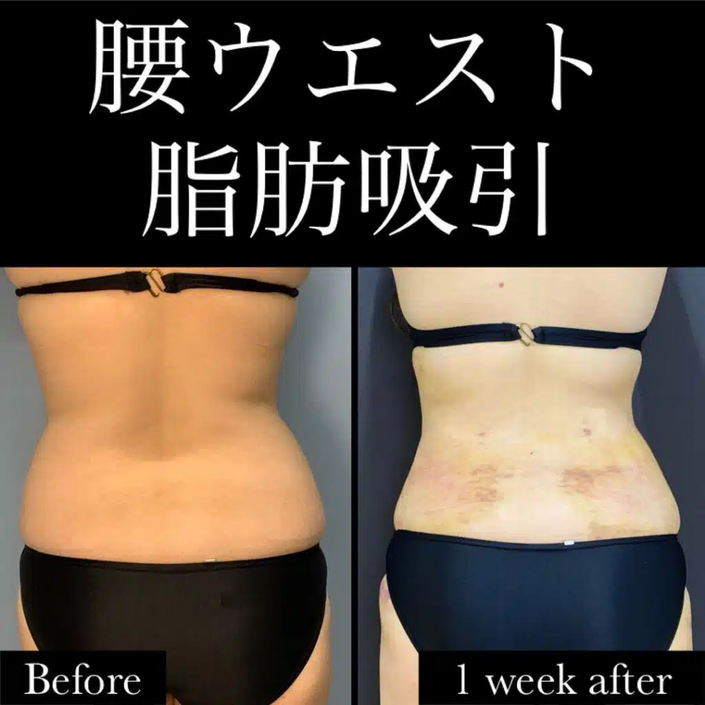 腰ウエスト脂肪吸引　名古屋
