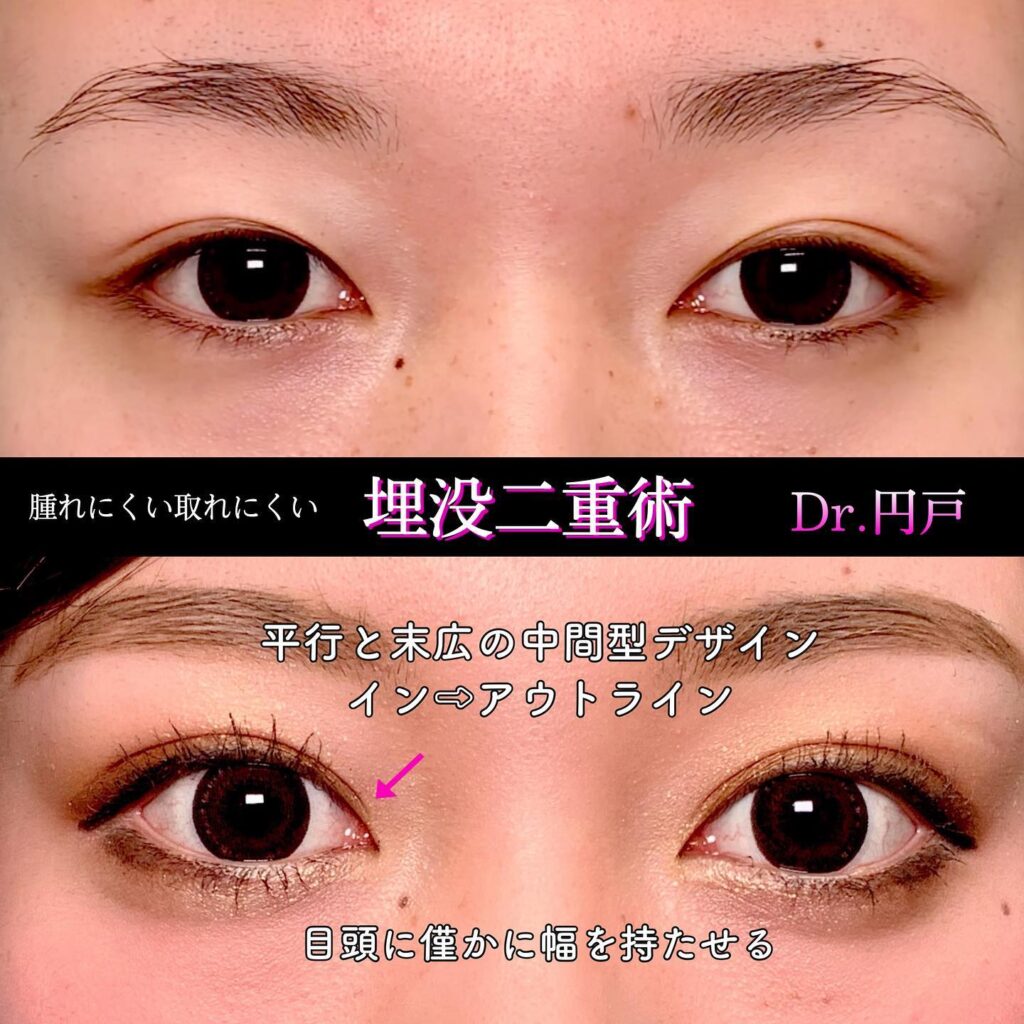 埋没法の症例写真 (2)