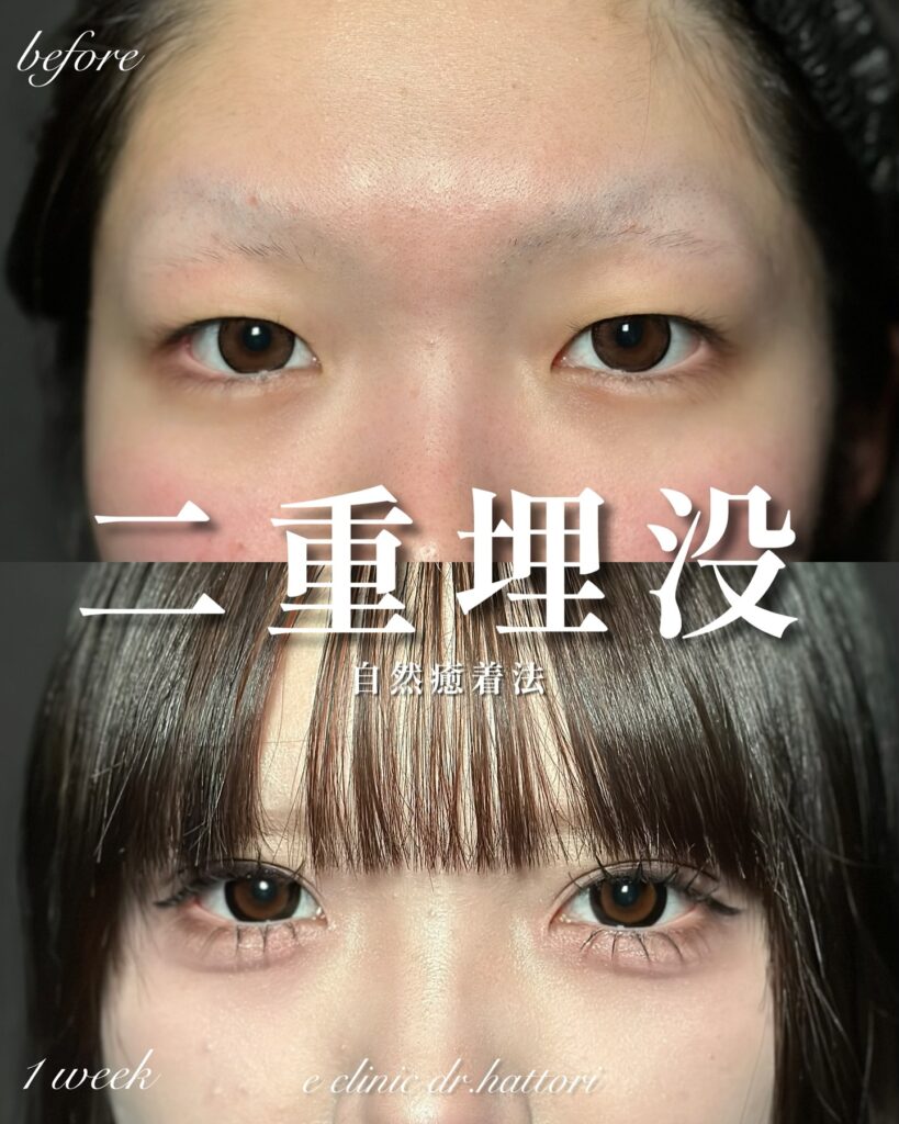 埋没法の症例写真 (2)