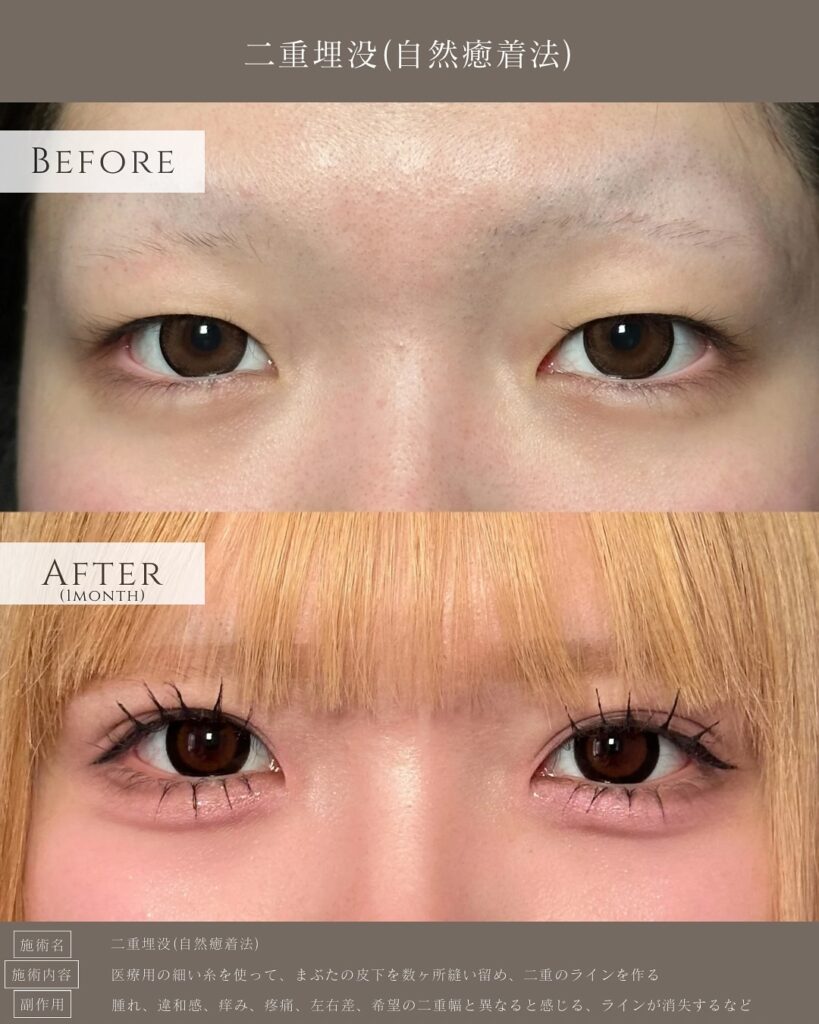 目頭切開の症例写真