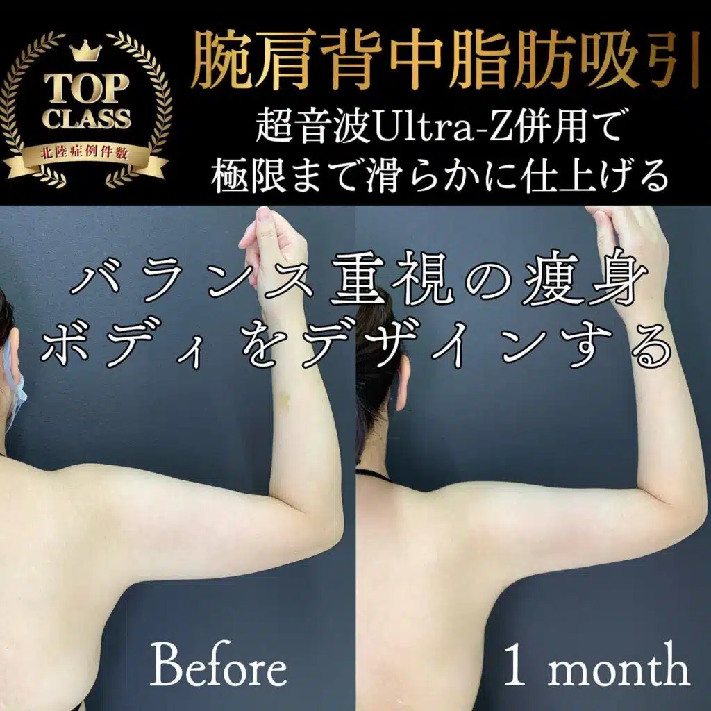 腕肩背中脂肪吸引　名古屋