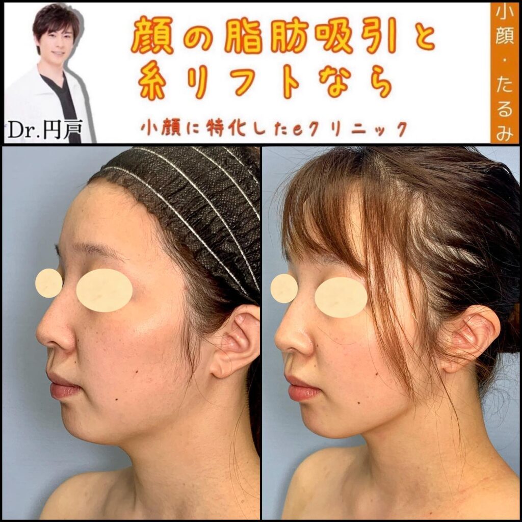 顔の脂肪吸引と糸リフトの症例写真