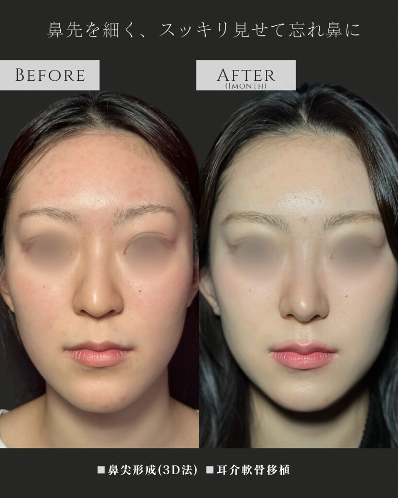 鼻尖形成と耳介軟骨移植の症例写真