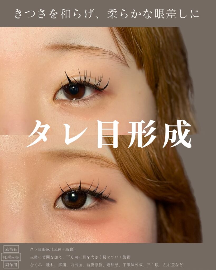タレ目形成の症例写真 (3)