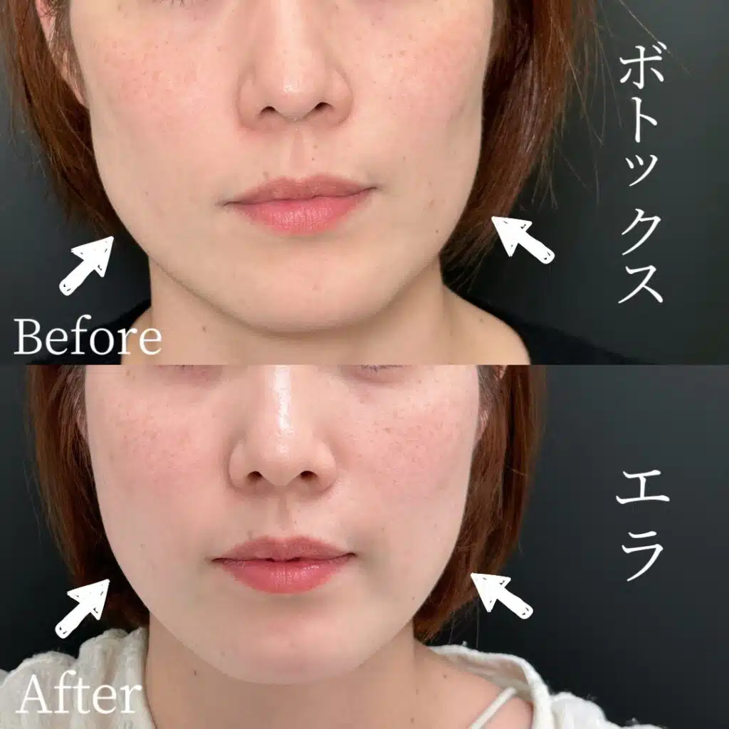 エラボトックス　名古屋