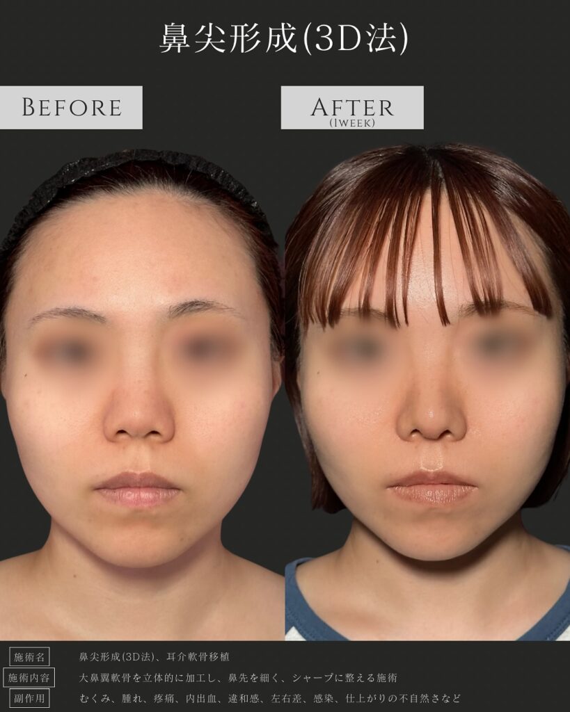 鼻尖形成3D法の症例写真