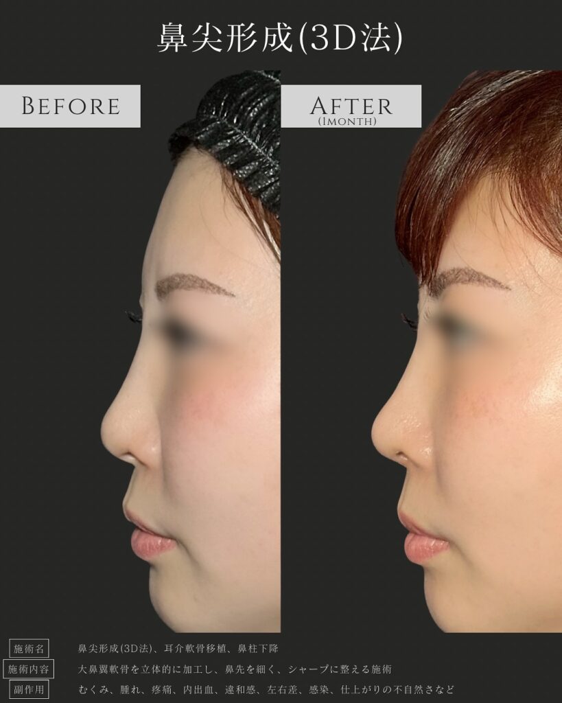鼻尖形成3D法の症例写真 (1)