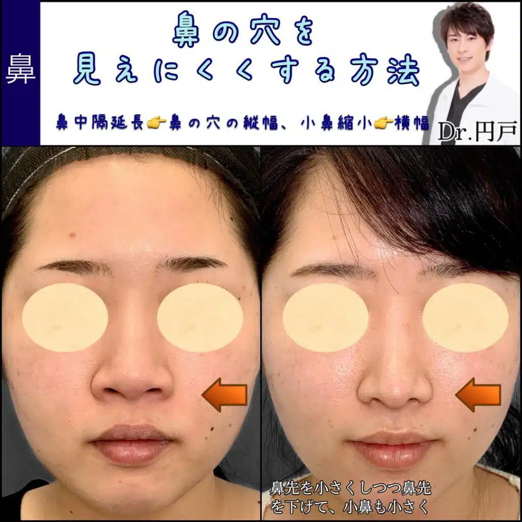 鼻中隔延長　小鼻縮小　名古屋
