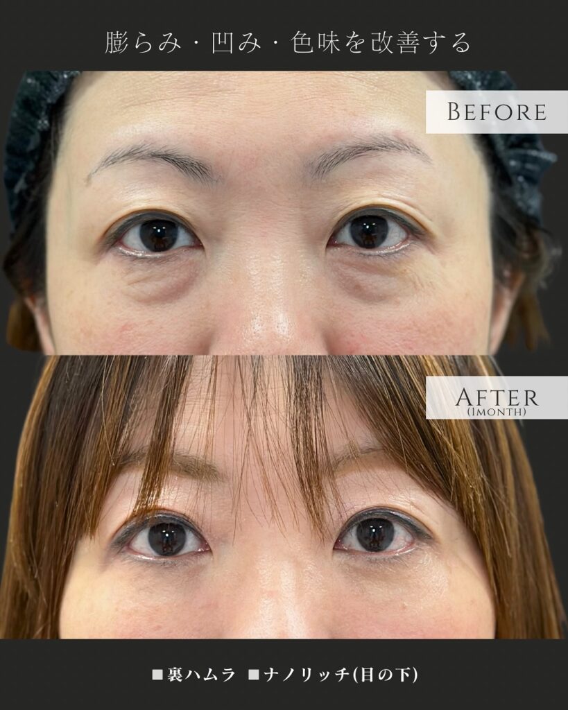 裏ハムラ法とナノリッチの症例写真