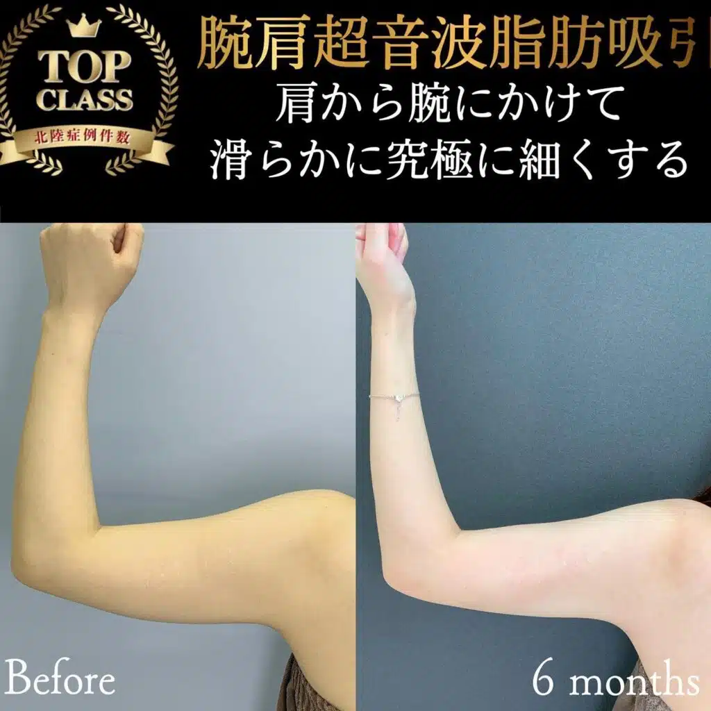 腕肩超音波脂肪吸引　名古屋