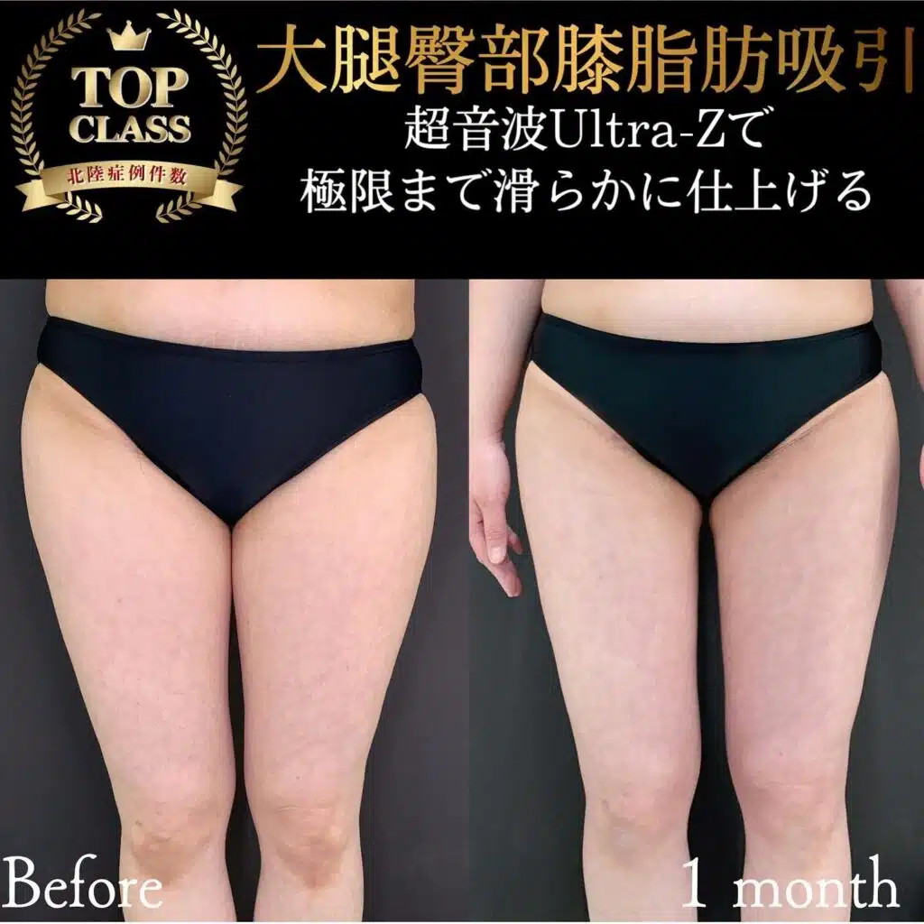 大腿臀部膝脂肪吸引　名古屋