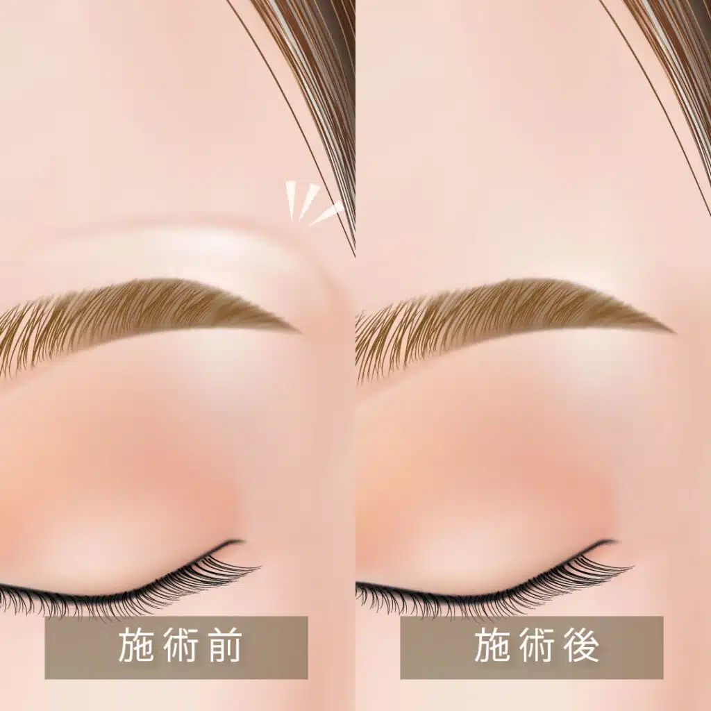 眉上ボトックスの図解　名古屋