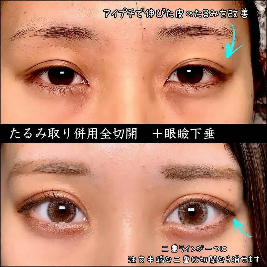 たるみ取り併用全切開+眼瞼下垂　名古屋