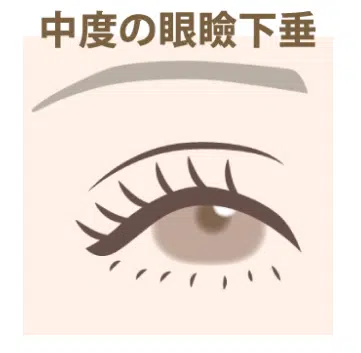 中度の眼瞼下垂　名古屋