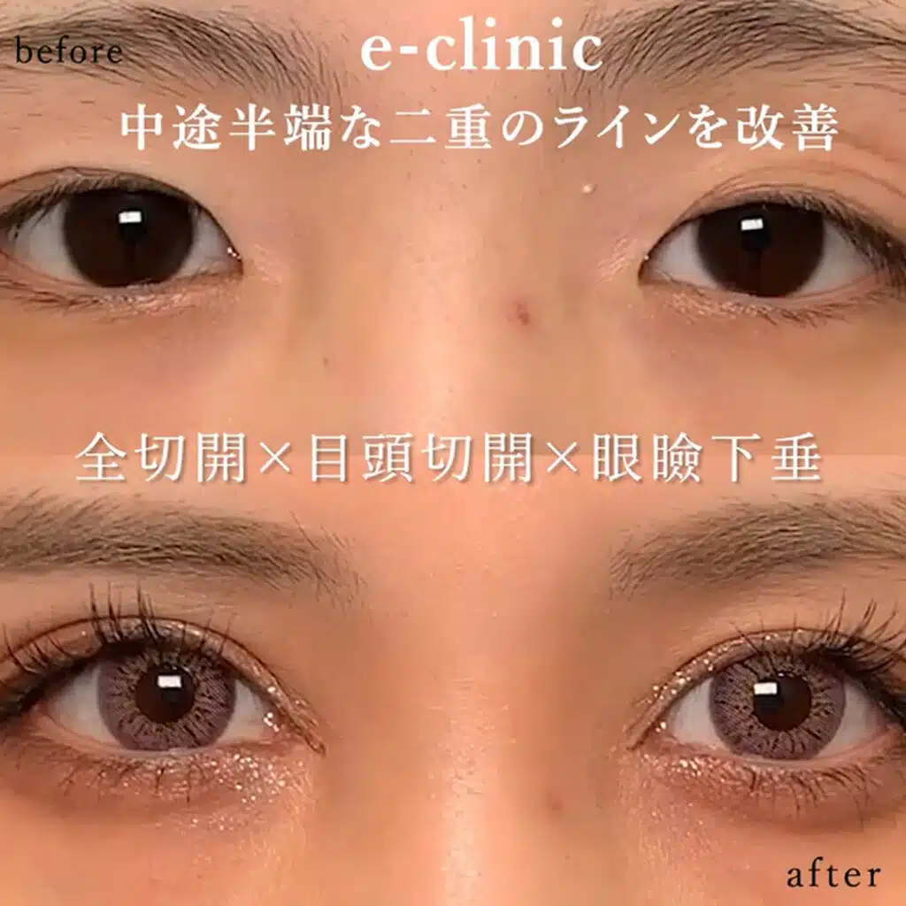 全切開×目頭切開×眼瞼下垂　名古屋