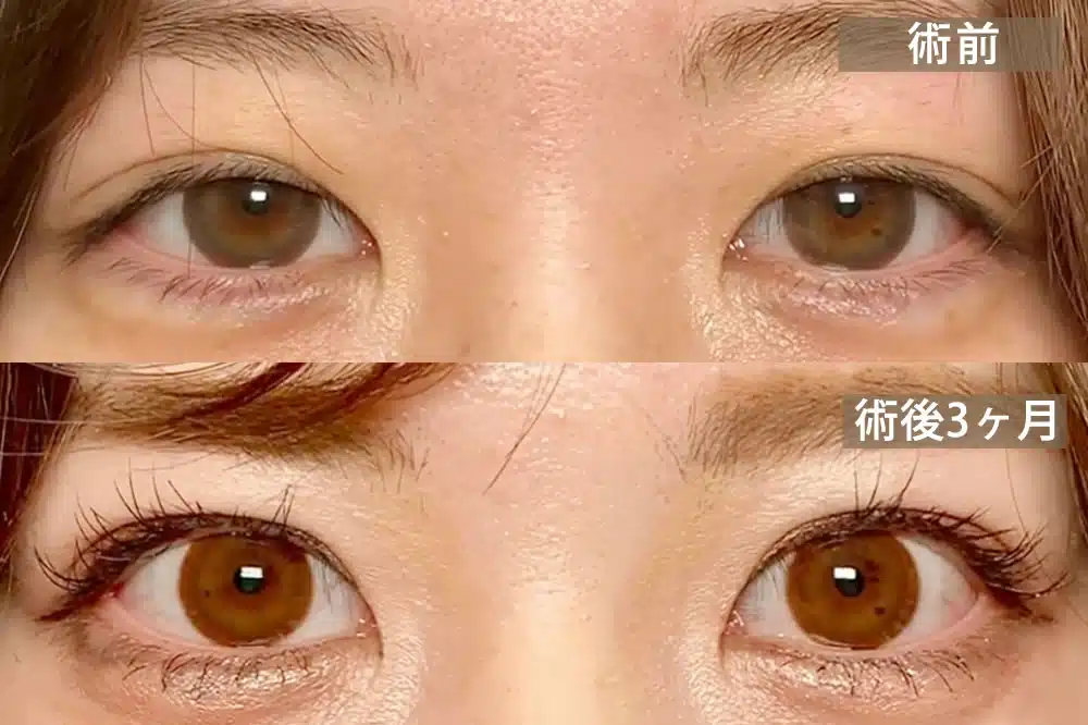 先天性眼瞼下垂　名古屋