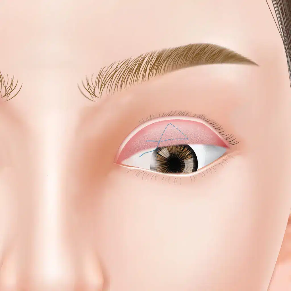 眼瞼下垂　手術方法　名古屋