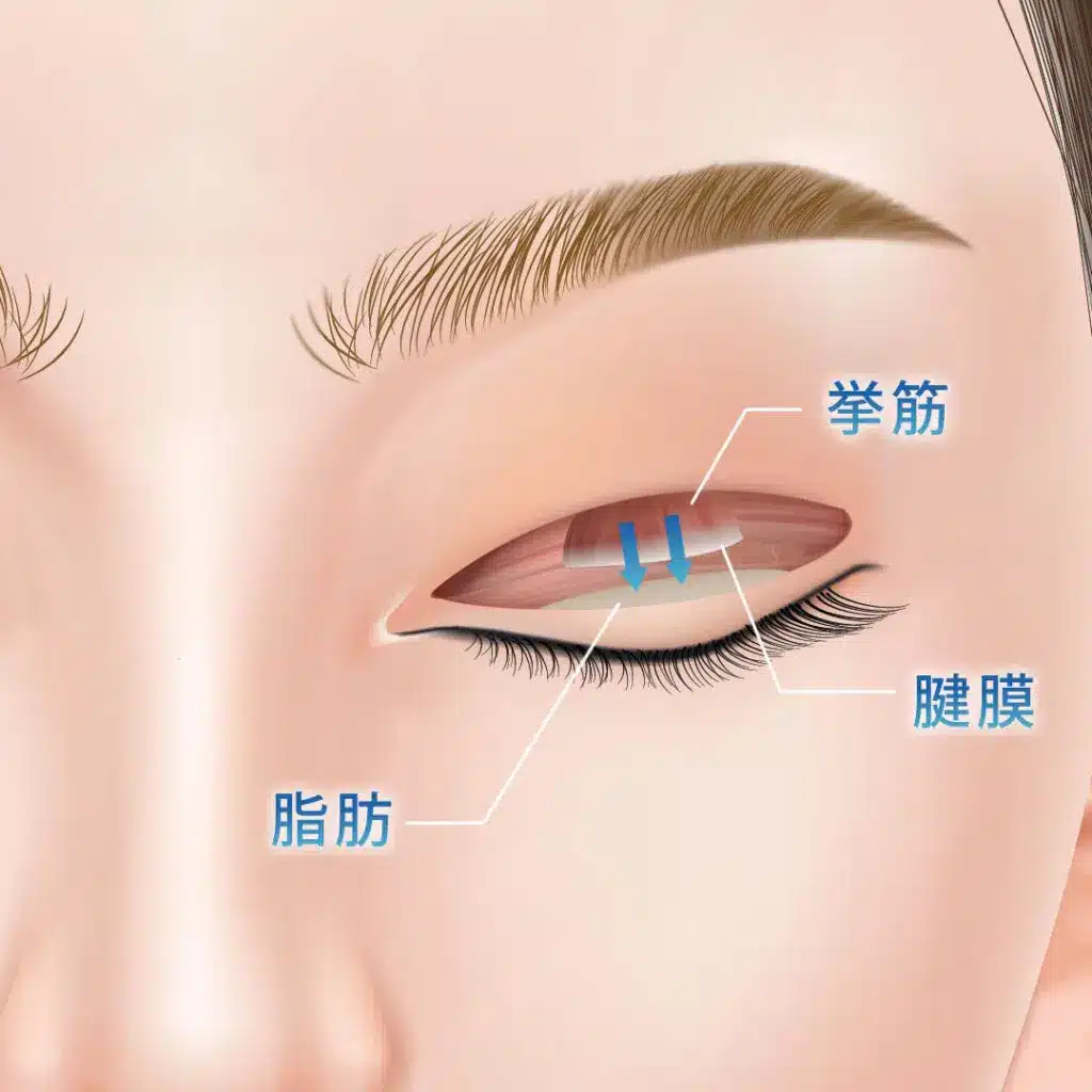 眼瞼下垂　手術方法　名古屋