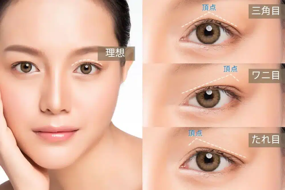 眼瞼下垂の失敗例の説明　名古屋