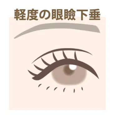 軽度の眼瞼下垂　名古屋
