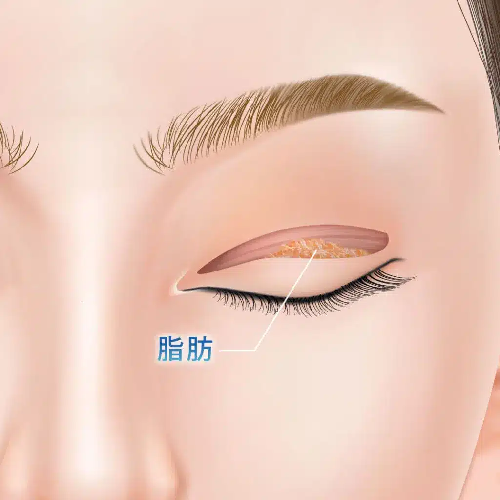 眼瞼下垂　手術方法　名古屋