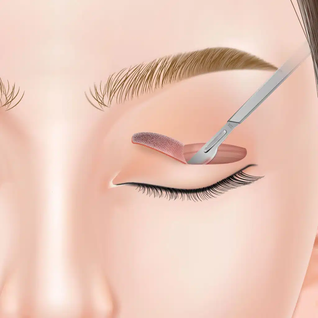 眼瞼下垂　手術方法　名古屋