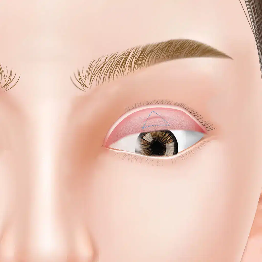 眼瞼下垂　手術方法　名古屋