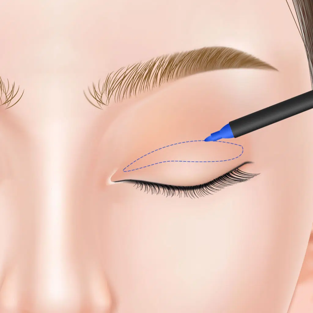 眼瞼下垂　手術方法　名古屋