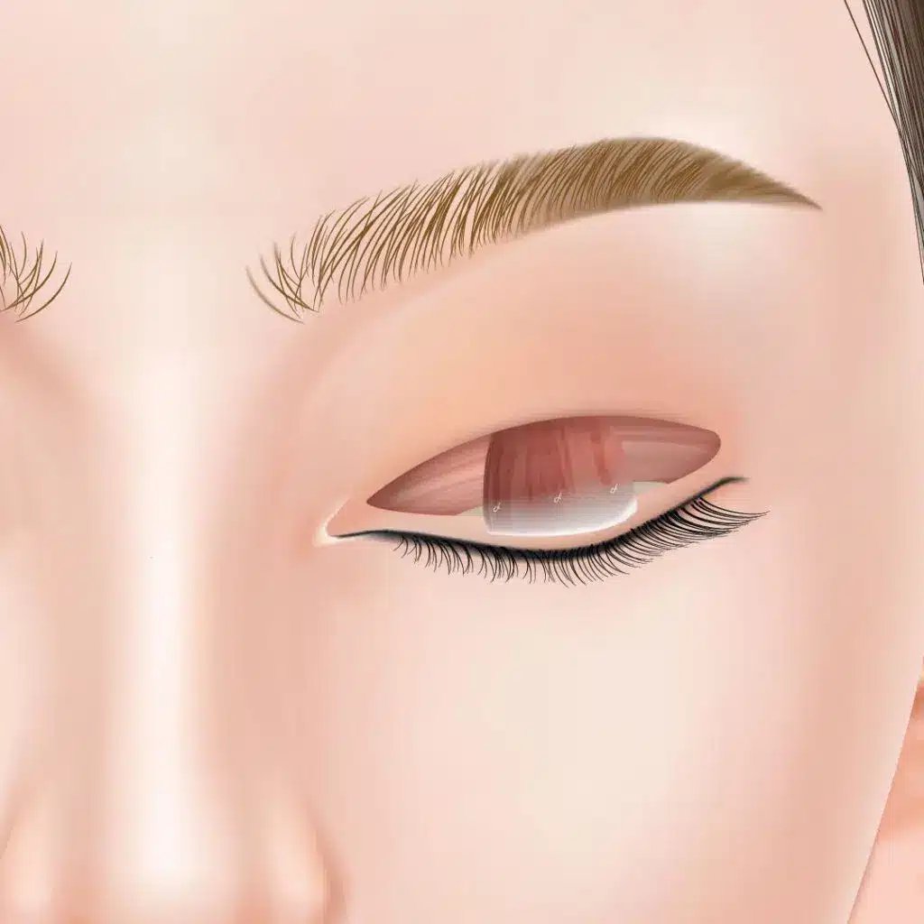 眼瞼下垂　手術方法　名古屋