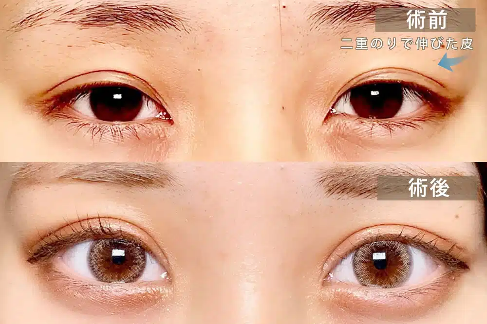 偽眼瞼下垂　名古屋