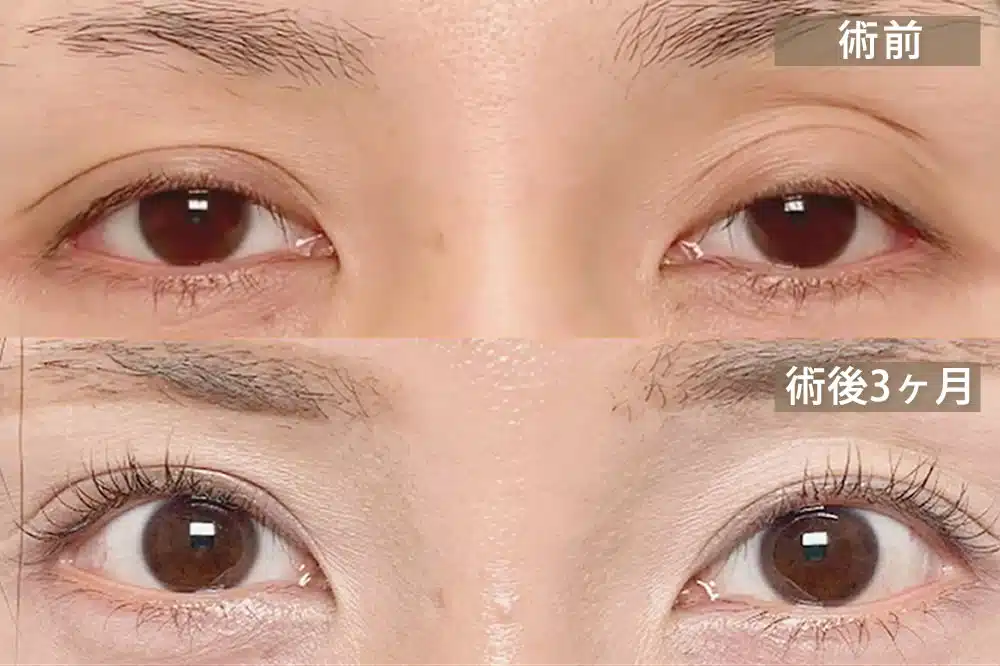 腱膜性眼瞼下垂（後天性眼瞼下垂）　名古屋