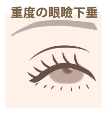 重度の眼瞼下垂　名古屋