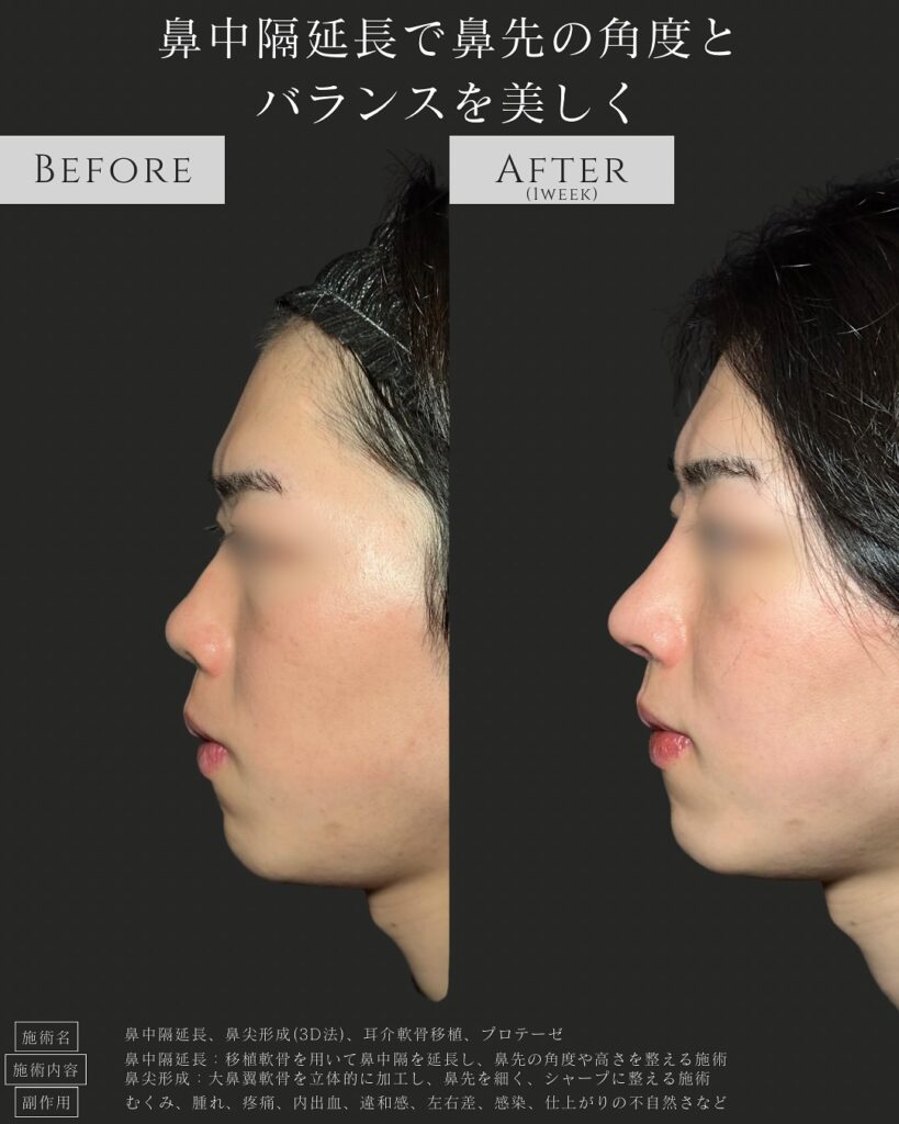 鼻中隔延長と鼻尖形成と耳介軟骨移植とプロテーゼの症例写真 (3)