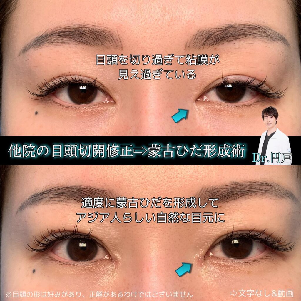 目頭切開の他院修正 (1)