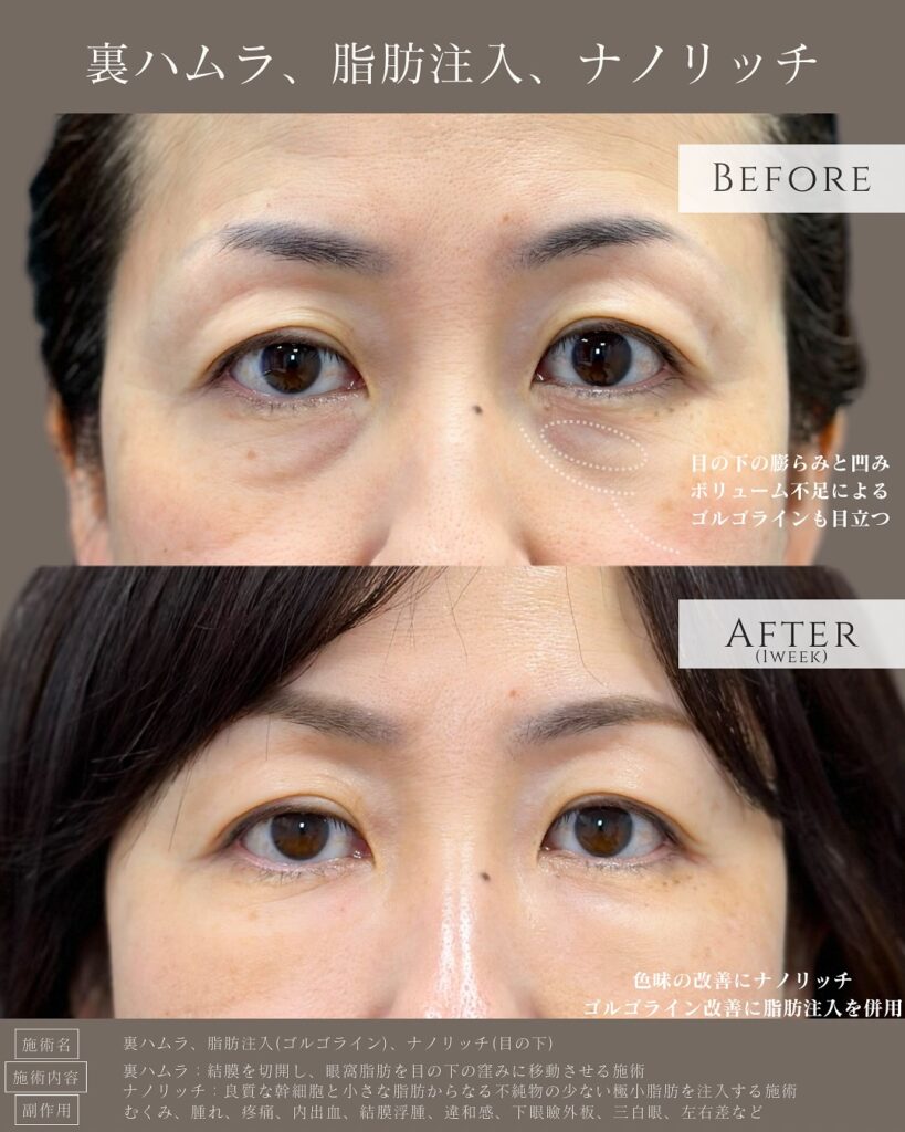 裏ハムラ法とナノリッチの症例写真 (14)